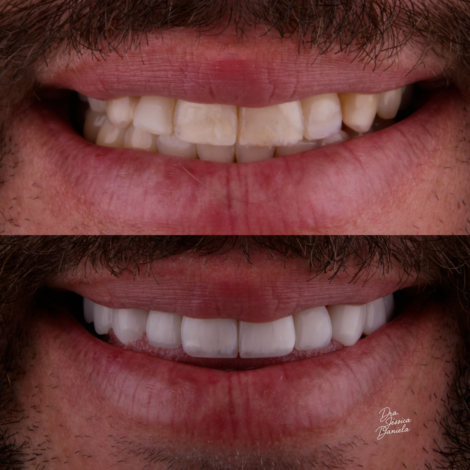 Antes e depois de harmonização orofacial