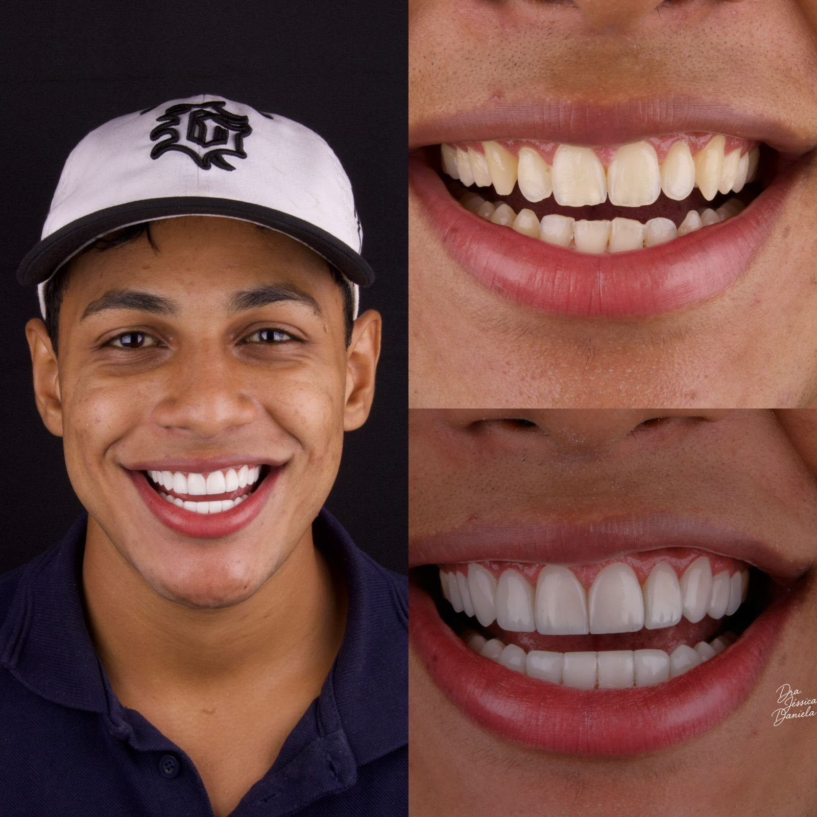 Resultado de harmonização orofacial
