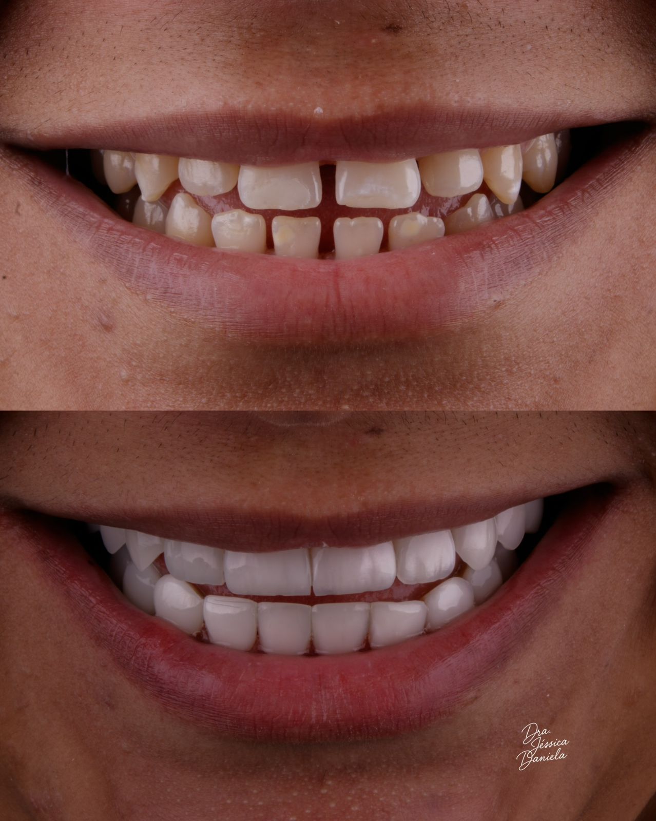Resultado de estética dental com facetas