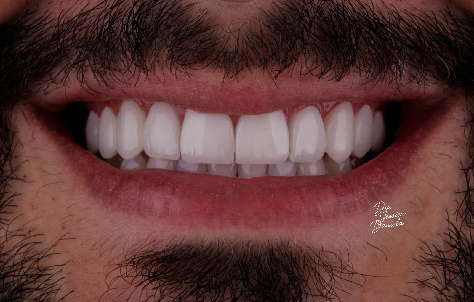 Antes e depois de transformação do sorriso