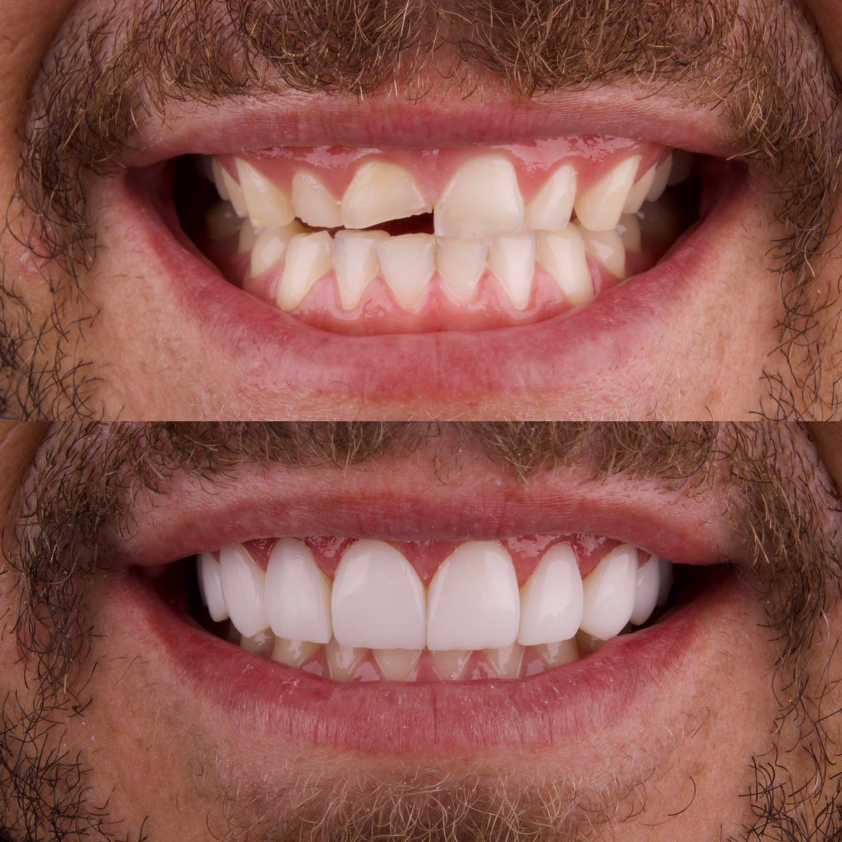 Caso de facetas em resina, antes e depois — dente fraturado