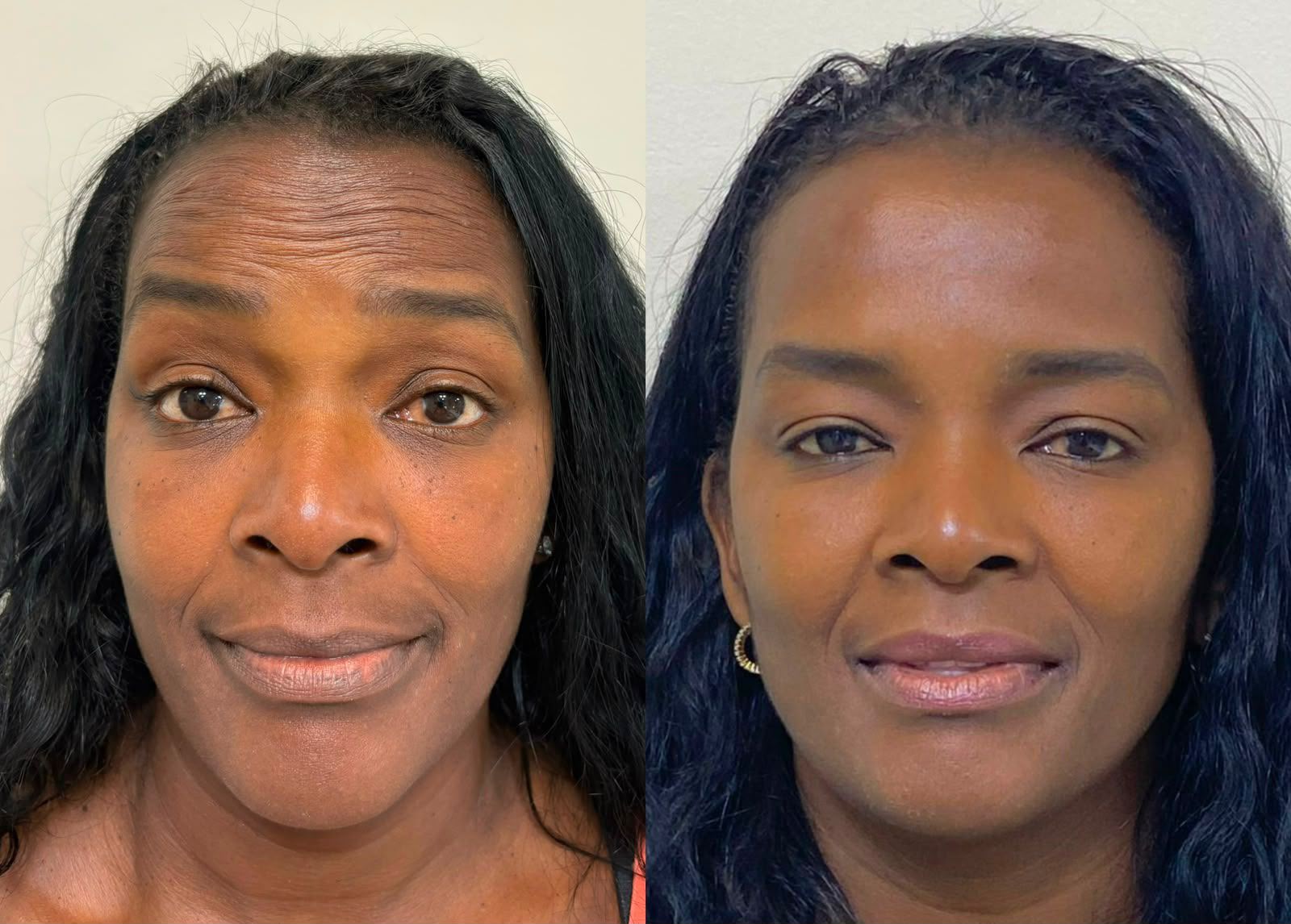 Antes e depois de harmonização orofacial com equilíbrio facial