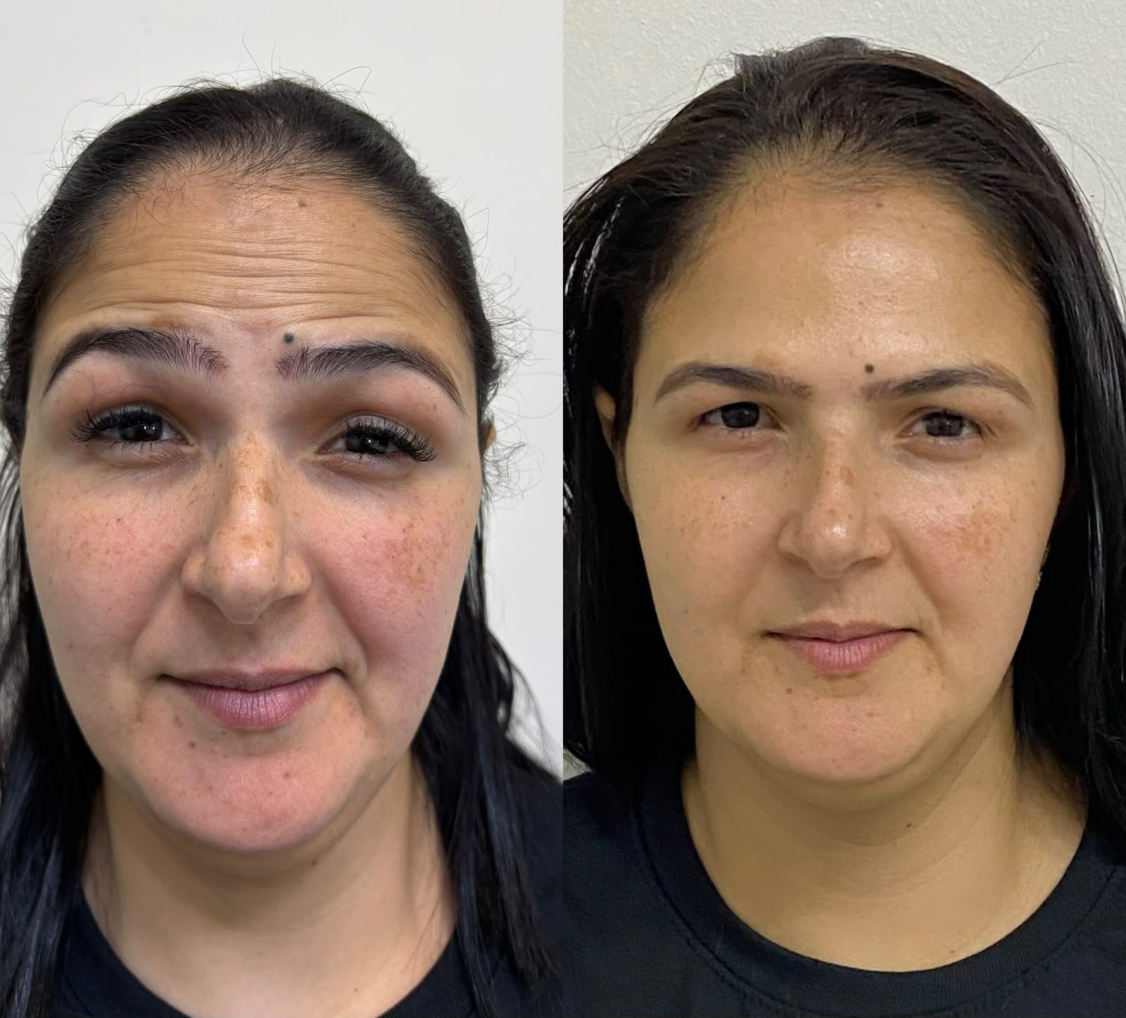 Caso clínico de harmonização orofacial com resultado natural
