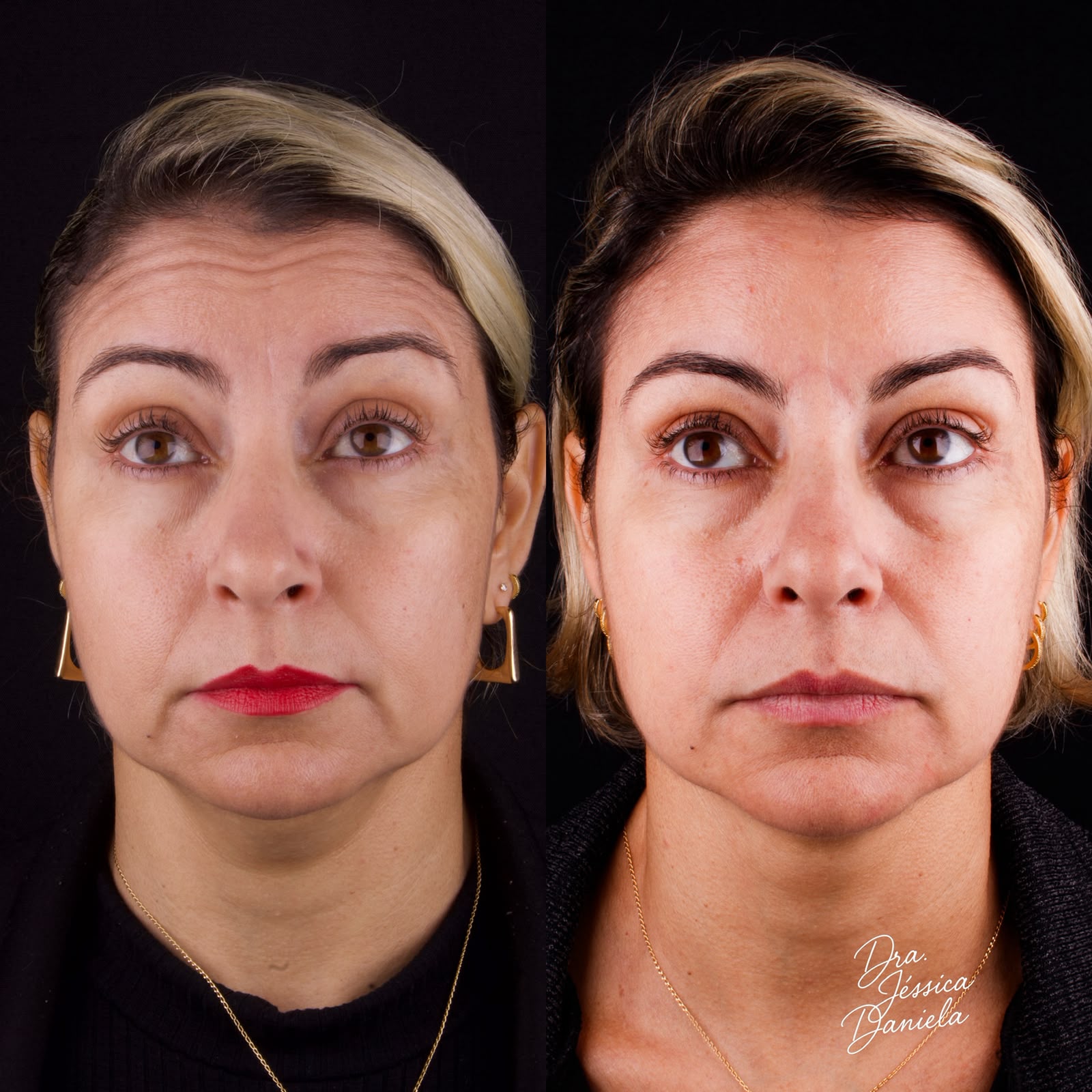 Antes e depois de harmonização facial com suavização de expressão