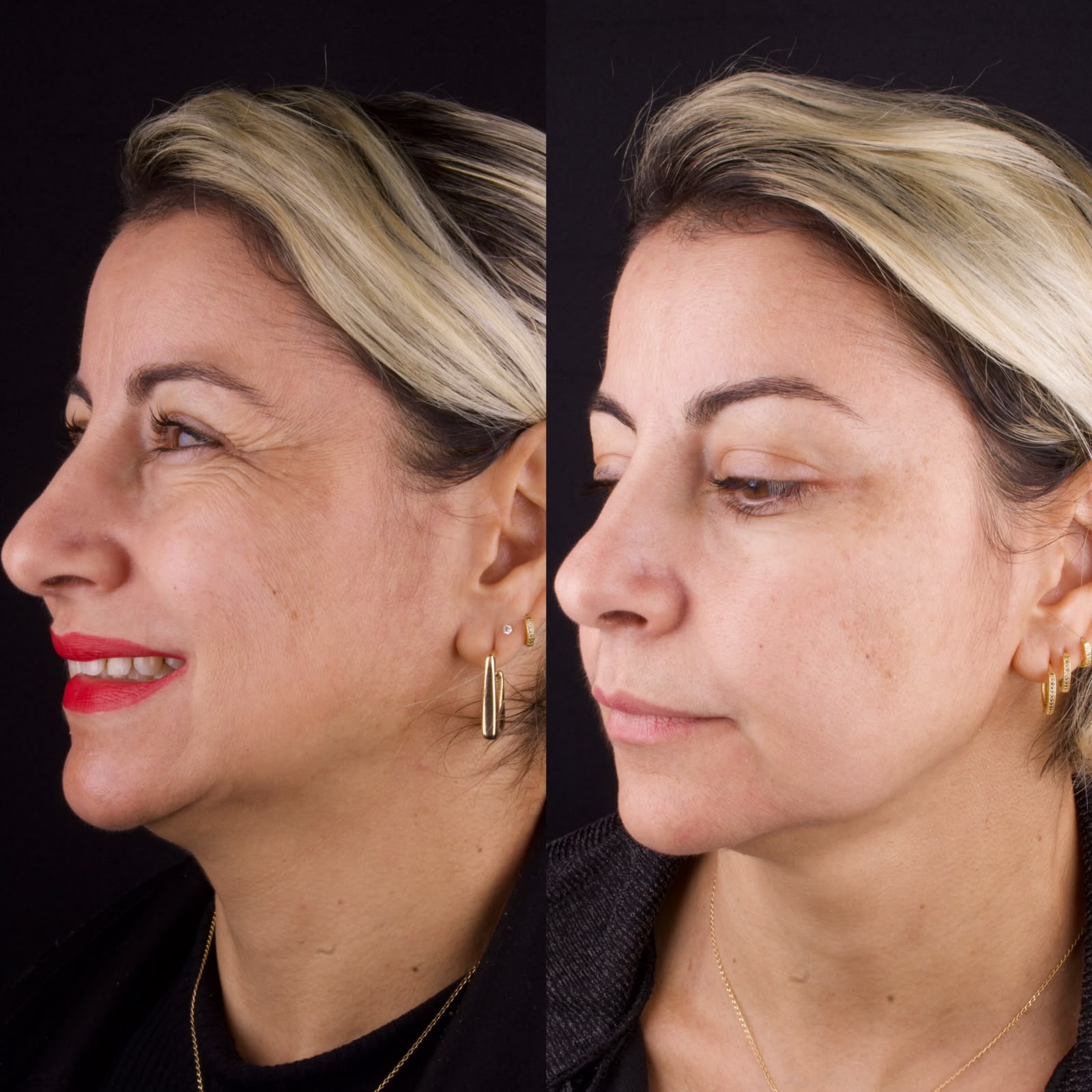 Resultado de harmonização orofacial em perfil facial