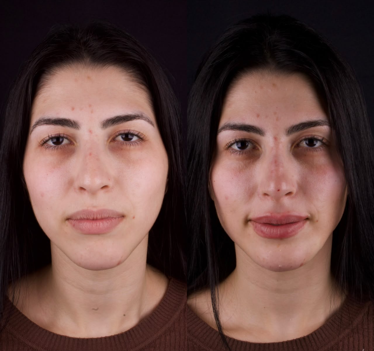 Antes e depois frontal de harmonização orofacial com resultado natural