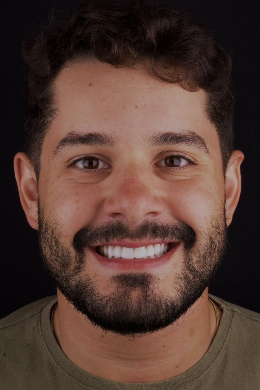 Sorriso masculino com facetas em resina composta